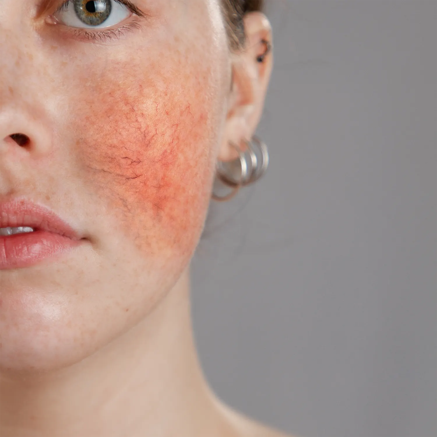 Rosacea Hautbild