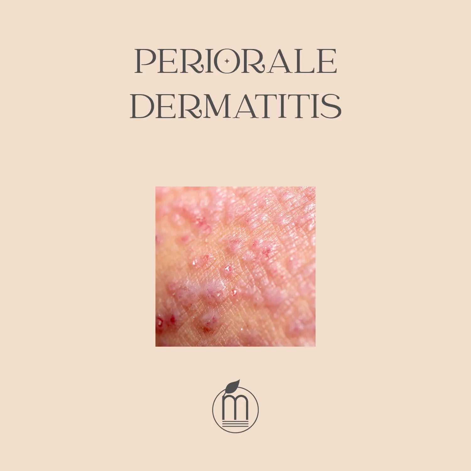 Periorale Dermatitis